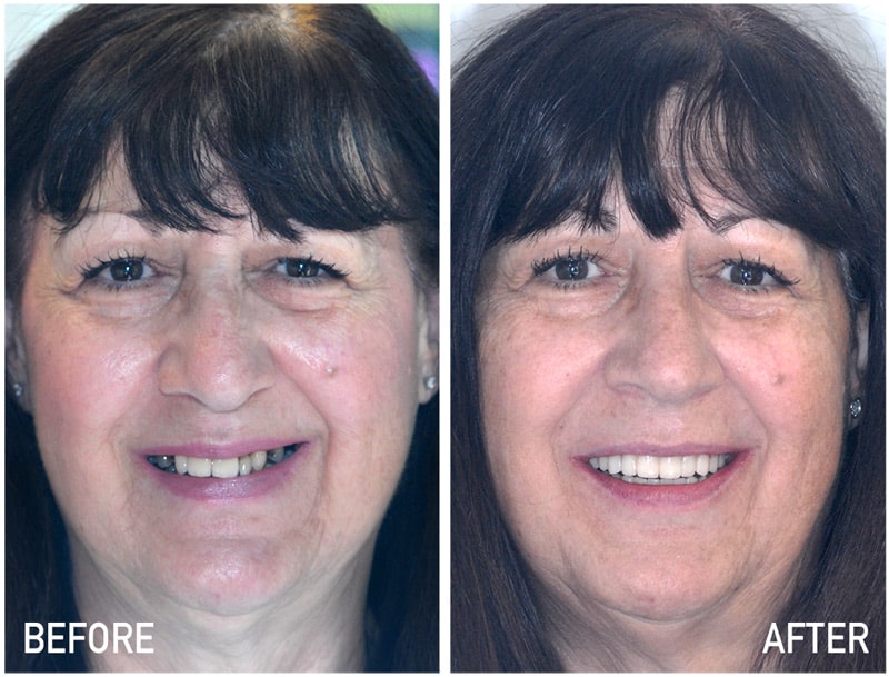 Cilia Before & After Dental Implant