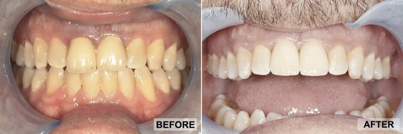 Before and After - CAREY