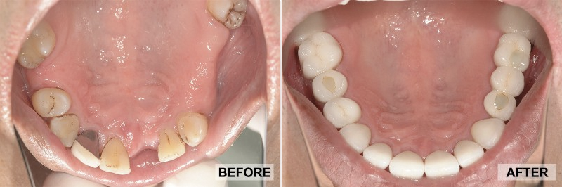 Before and After - Andrew