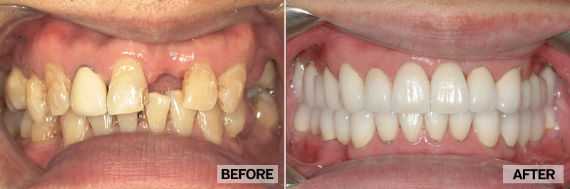 Before and After - James