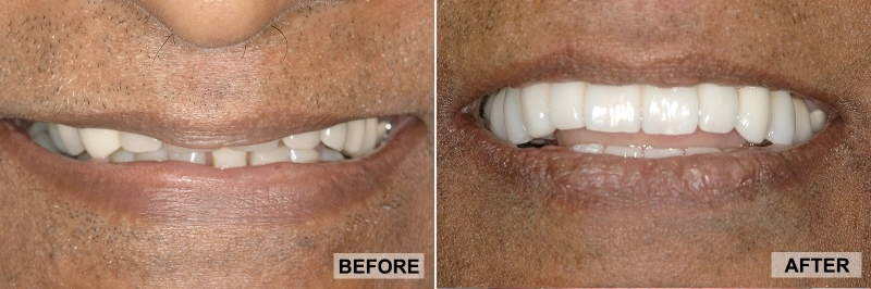 Before and After - Jim