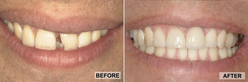 Before and After - JUERGEN