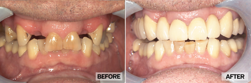 Before and After - Mike