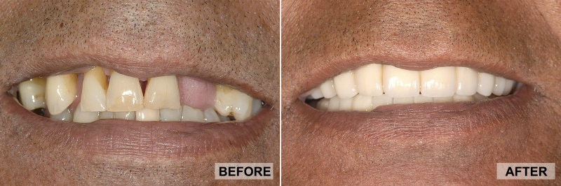 Before and After - Peter