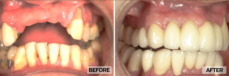 Before and After - Rudy